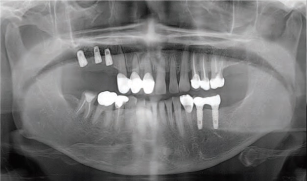 
شکل2: تصویربرداری رادیوگرافی بعد از عمل جراحی
