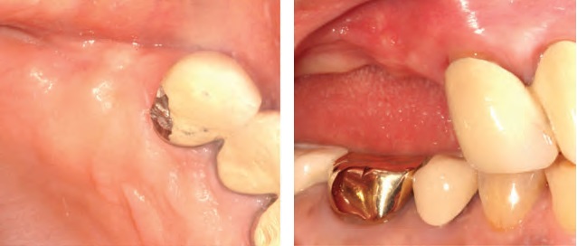 
شکل3: عکس بالینی قبل از عمل. چپ: نمای occlusal. راست: نمای lateral.
