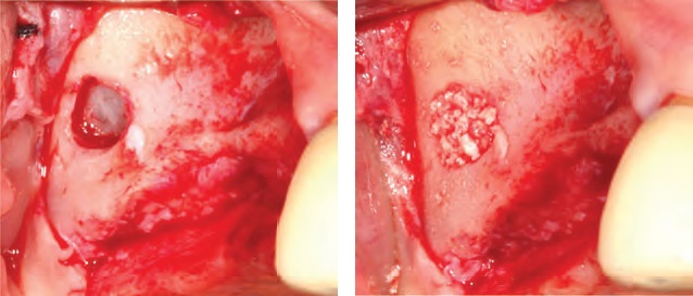 
شکل4: جراحی سینوس لیفت lateral. چپ: بازکردن پنجره در استخوان. راست: پرکردن حفره با پودر استخوان
