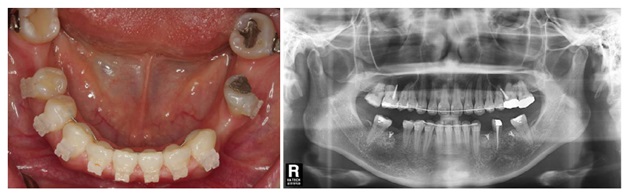  Fig.1. Intra-oral and preoperative radiographic findings. Thin mandibular ridge is seen in extracted site
