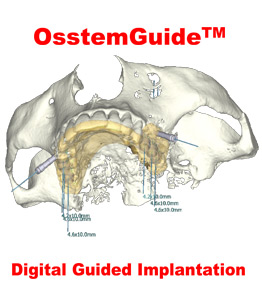 کیت Guide آستم | osstem guide 